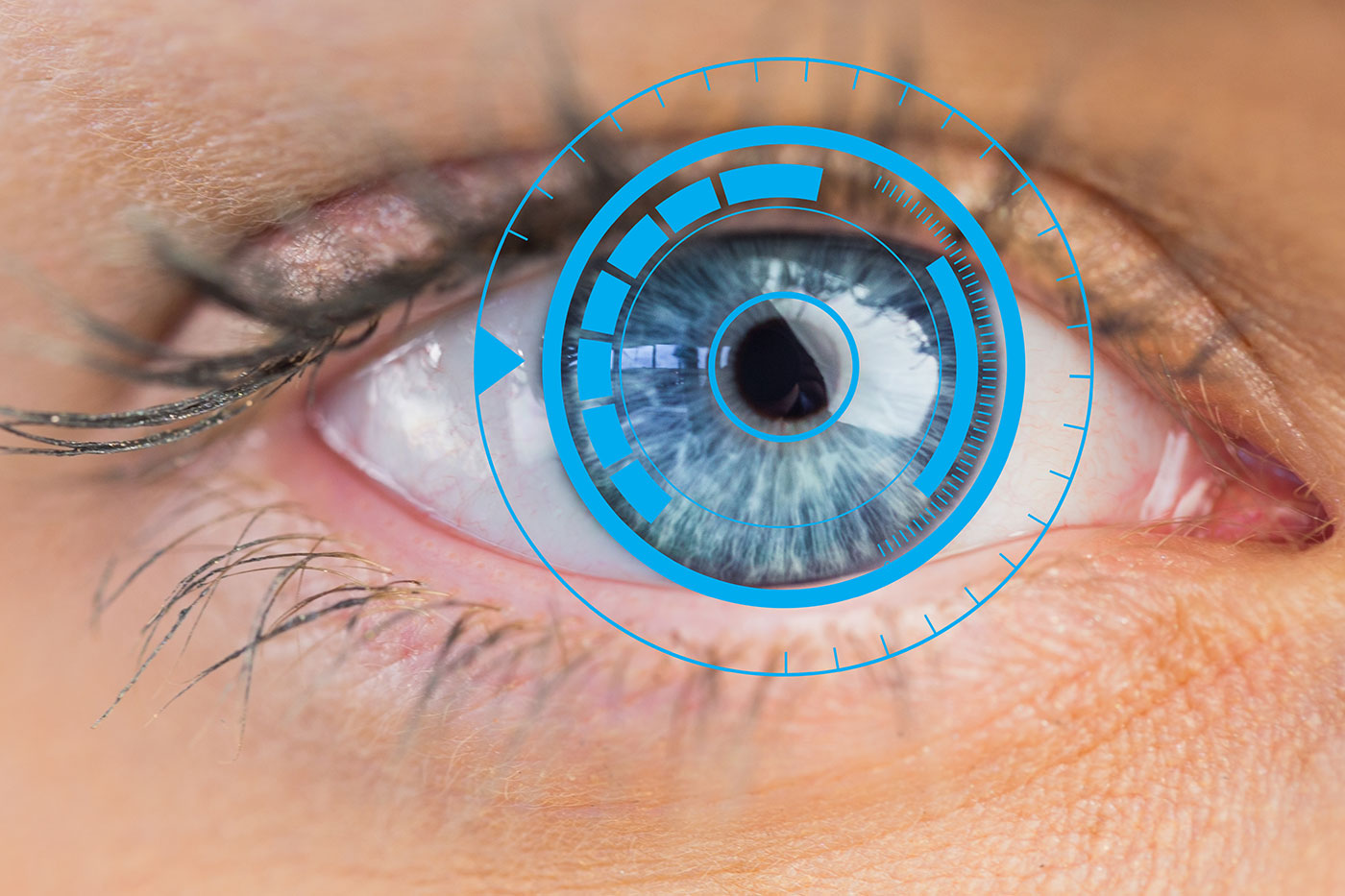 Transpkr ou Lasik